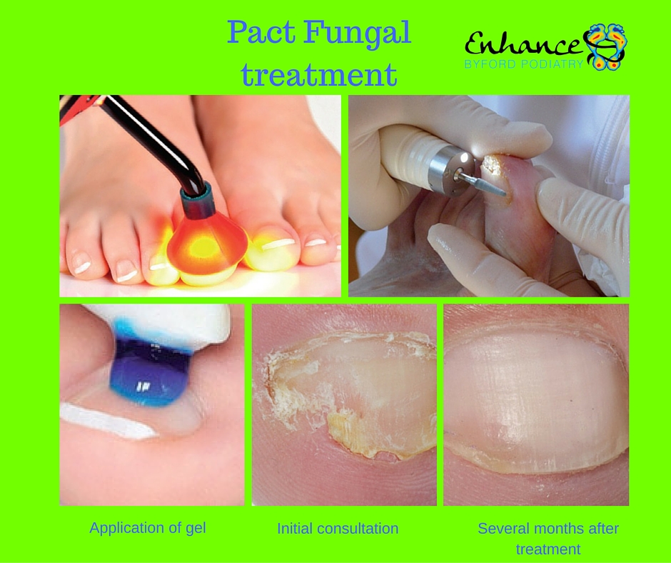 Pact_Fungal_treatment-_byford